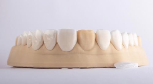 porcelain-veneers