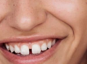 Diastema gab between your teeth expat dental